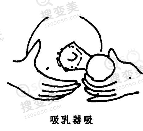 乳头内陷怎么进行矫正，为什么会出现乳头内陷的情况