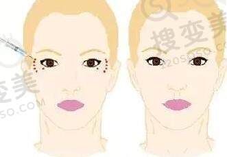 面部填充时自体脂肪和玻尿酸该如何选择？