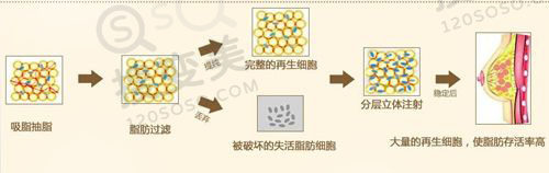 自体脂肪隆胸之后多久进行二填效果*好