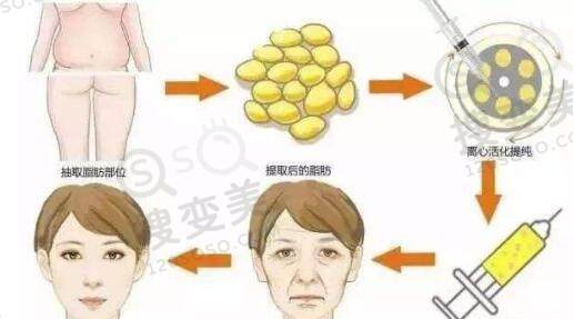 自体脂肪除皱需要恢复多久？