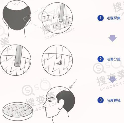 植发应该了解的几个问题