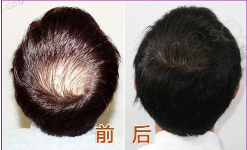 植发应该了解的几个问题