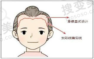 植发应该了解的几个问题