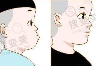 儿童地包天良好的矫正年龄是多少？