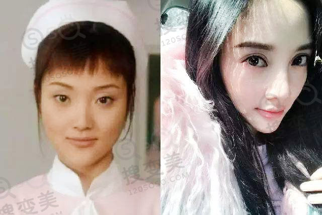 不适合割双眼皮的眼睛有哪些？