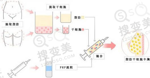 自体脂肪丰胸多久才能稳定