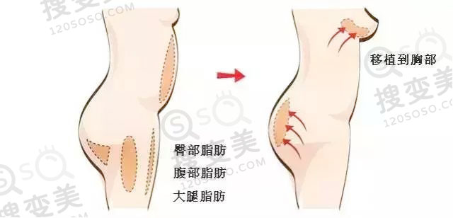 自体脂肪丰胸后产生的结节会癌变吗