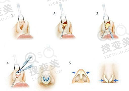 硅胶假体隆鼻需要取出吗