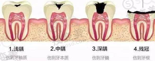 根管治疗是什么？哪种情况需要做根管治疗？