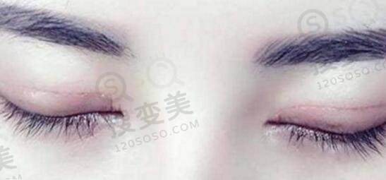 双眼皮修复的注意事项？