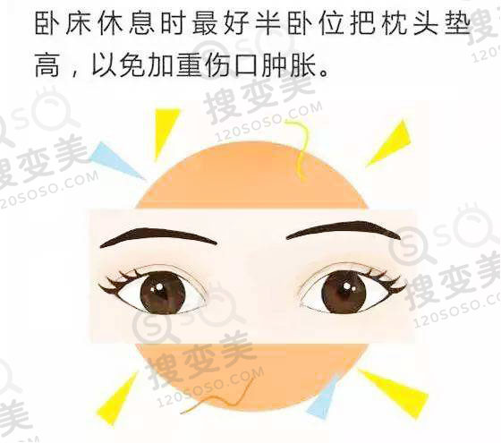 割双眼皮后伤口怎样才能恢复快？