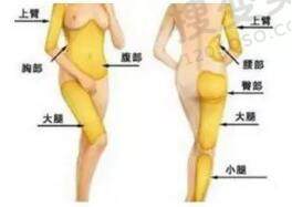 做全身吸脂好吗？
