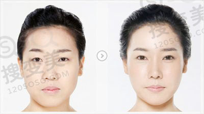 假体隆鼻失败了怎么办？该如何修复？