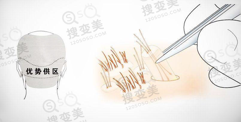 植发后脱发严重是怎么回事？