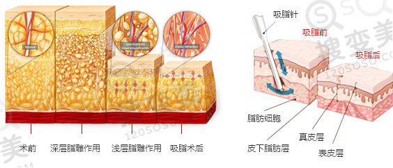 腰腹吸脂容易反弹吗