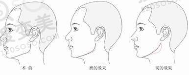 下颌角整形会留疤吗？