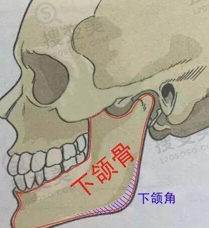 下颌角整形会留疤吗？