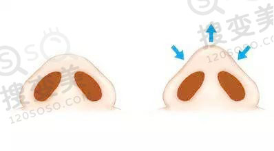 鼻头太大做鼻头缩小手术有几种方法