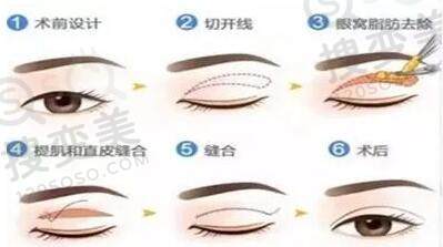 肿泡眼适合哪种双眼皮？