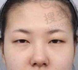 肿泡眼适合哪种双眼皮？