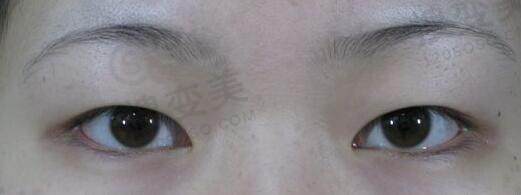 肿泡眼适合哪种双眼皮？