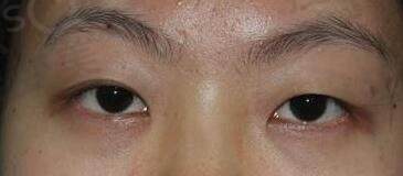 肿泡眼适合哪种双眼皮？