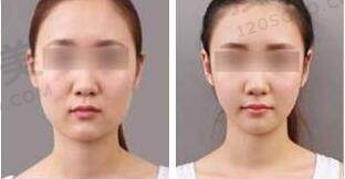 除皱瘦脸的用处及注意事项是什么？