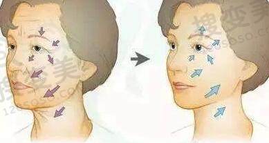 除皱瘦脸的用处及注意事项是什么？