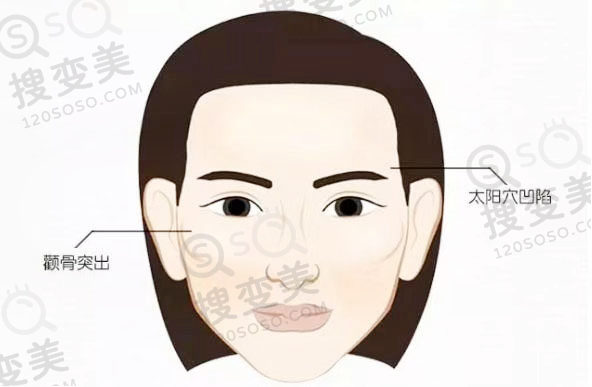 怎么选择颧骨内推还是丰太阳穴