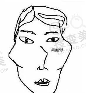怎么选择颧骨内推还是丰太阳穴