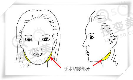 下颌角整形麻醉对大脑有影响吗?
