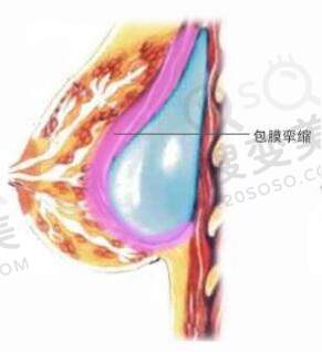 假体隆胸有什么风险？