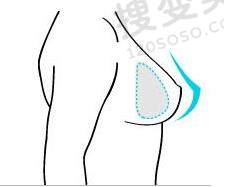 假体隆胸有什么风险？