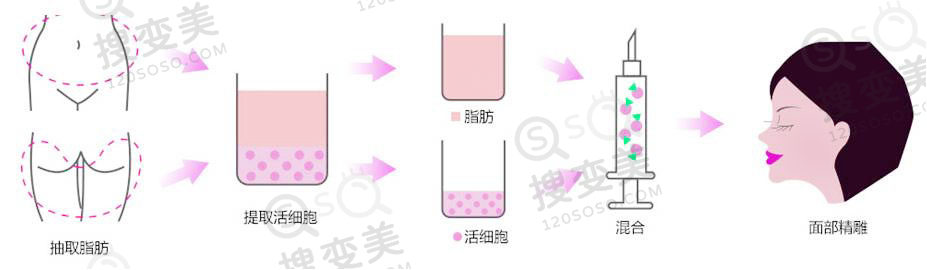 自体脂肪面部填充相比玻尿酸注射的优势
