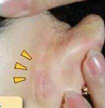 耳软骨隆鼻会被吸收吗？