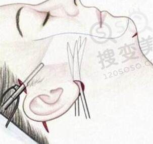 怎么消除面部皱纹？