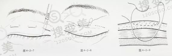 埋线双眼皮用的是什么线