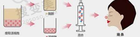自体脂肪隆鼻的术前术后注意事项