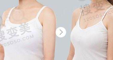 巨乳缩小的优势？