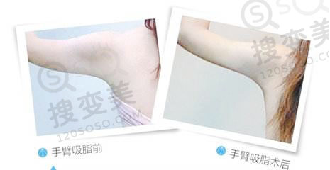 手臂吸脂应该选择什么方式？哪种方式*靠谱