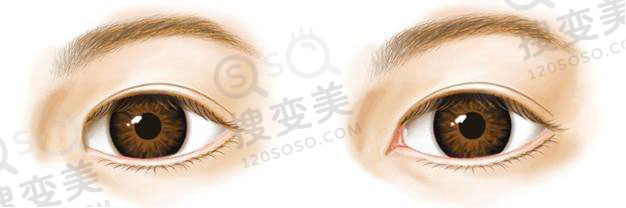 开眼角术后怎么护理才不会留疤？