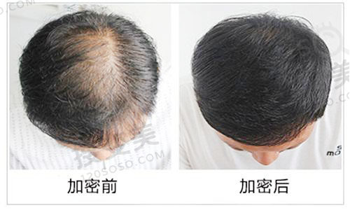 头发稀疏怎么办?头顶加密植发靠谱吗?