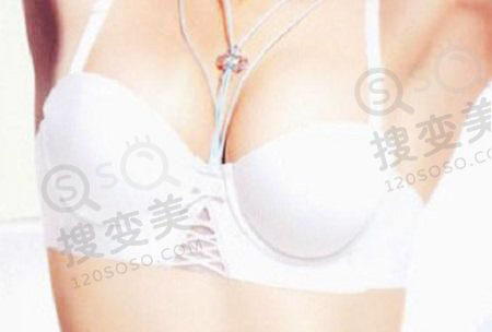 杭州隆胸哪家医院和医生做的好？