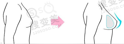 杭州假体隆胸假体能放在胸部多久？