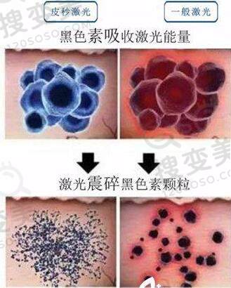 如何祛斑？