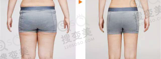 大腿环吸之后多久可以看到效果？大腿吸脂有用吗？
