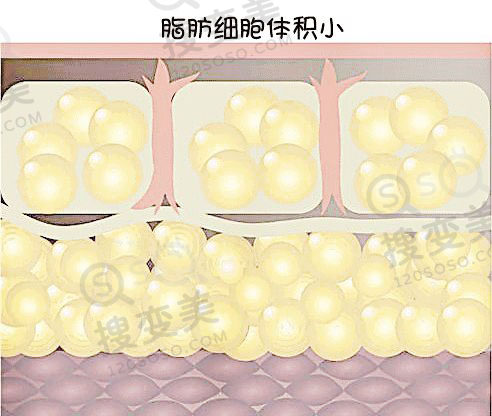 大腿环吸之后多久可以看到效果？大腿吸脂有用吗？