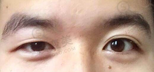 大小眼的矫正方法有哪些？