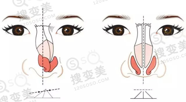 隆鼻碰撞后鼻子会歪吗