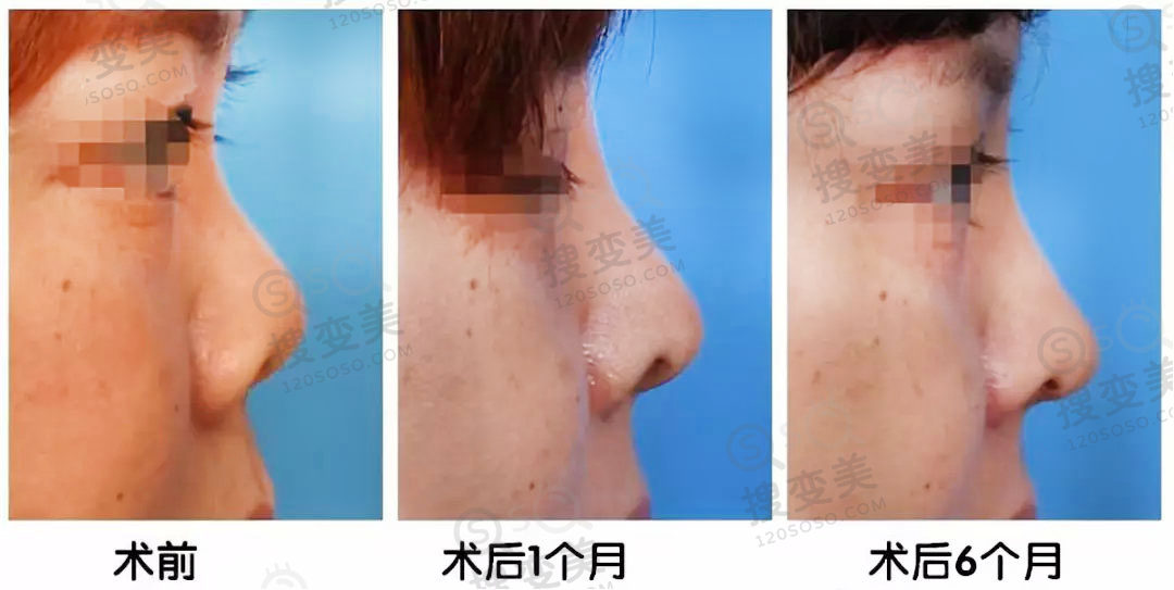 隆鼻碰撞后鼻子会歪吗